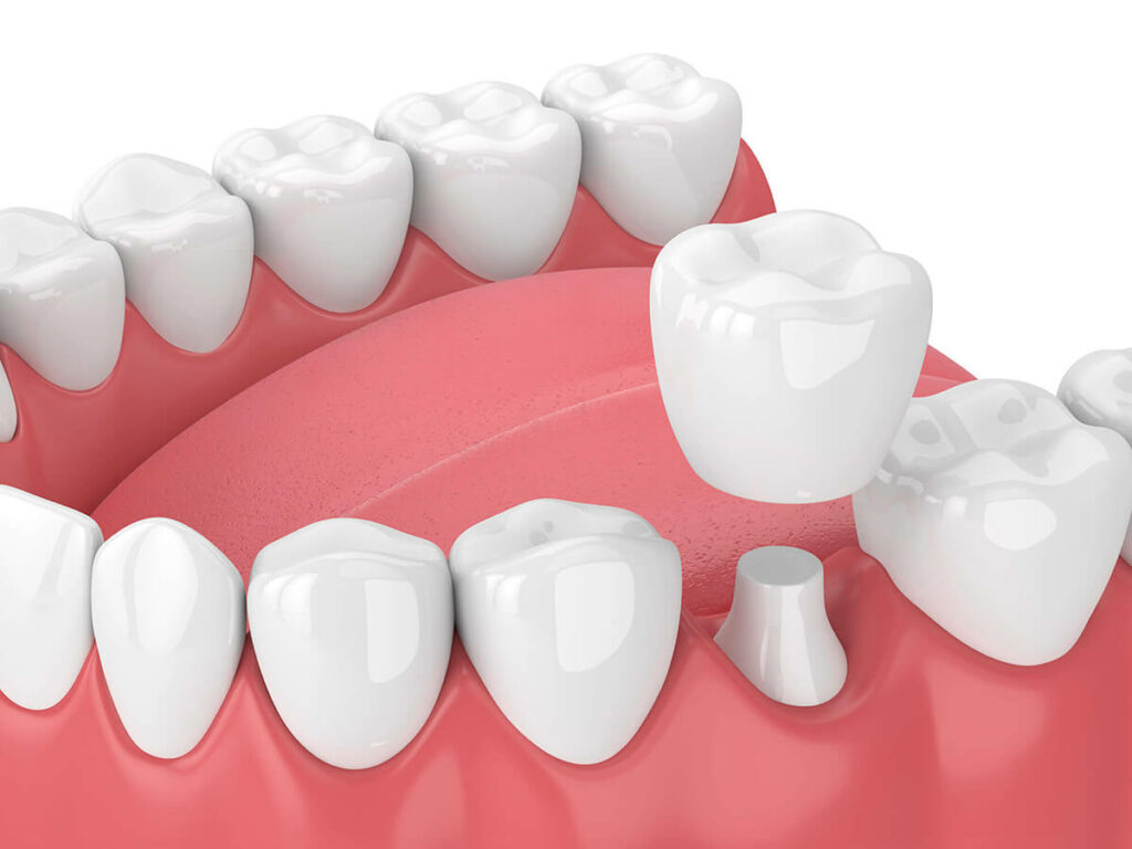 Dental crowns illustration