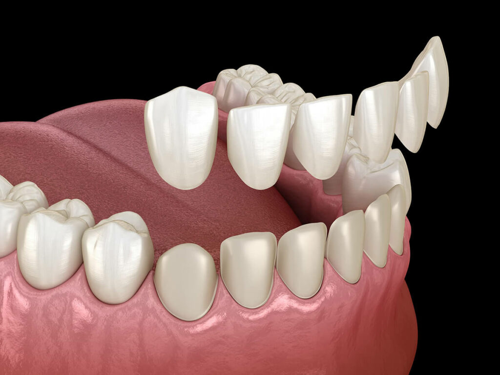 Dental veneers illustration