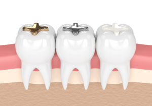 Graphic of dental fillings