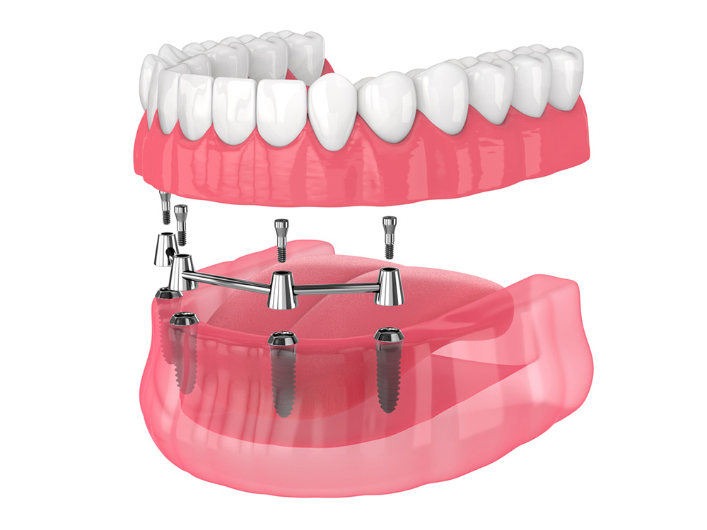All-On-4 Dental Implant illustration