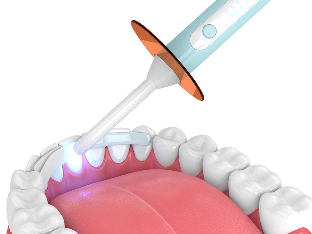 Illustration of dental bonding procedure